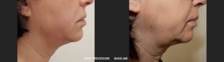 HIFU - Lifting sans chirurgie - Avant/Apres