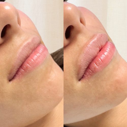 Injection des lèvres avant/après